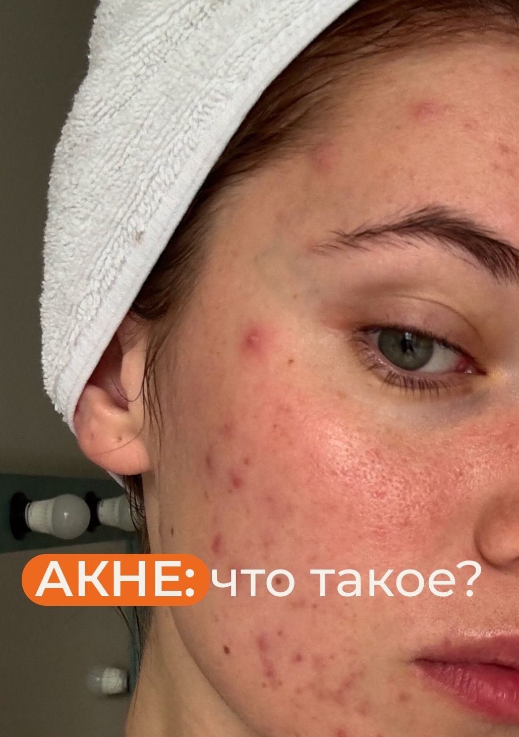 Акне, воспаления, прыщи