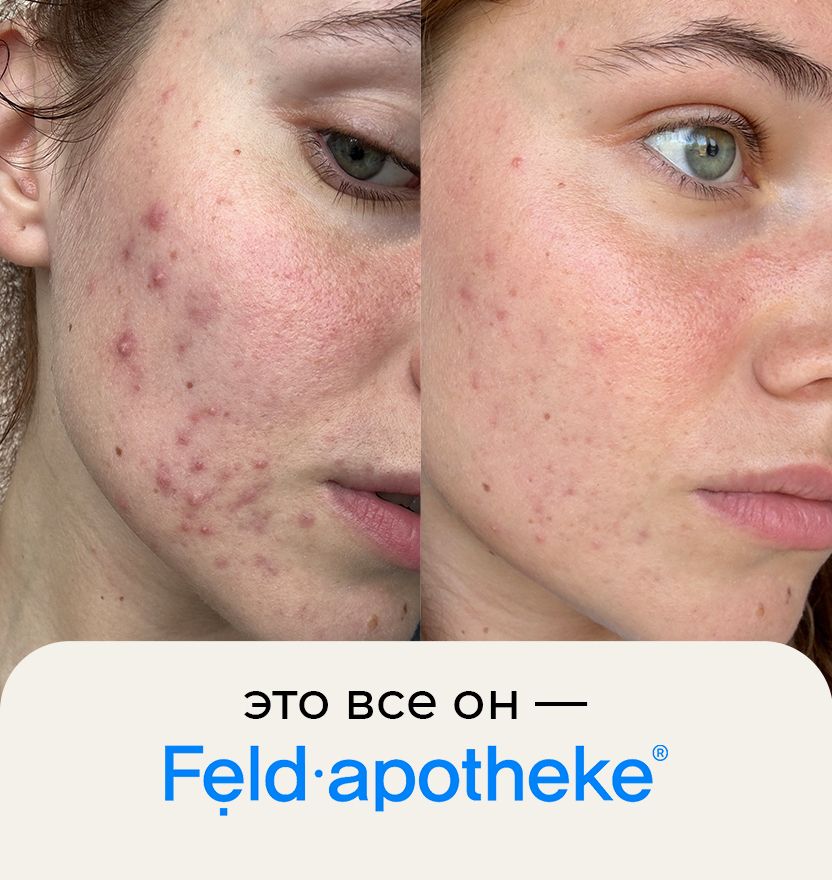 Кейс Анти-акне х Feld Apotheke